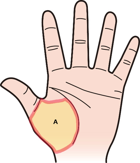 子どものほくろ診療案内あま市・名古屋市の皮膚科 ごとう皮フ科クリニック