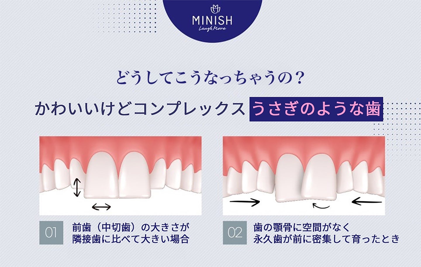 前歯が大きい ので、削って小さくして欲しい」というご要望を時々いただきます。ですが、よく見ると歯の大きさの不揃いではなく“歯並び”が影響している場合が多いです。この方も、上の 前歯２本がウサギの歯のように目立つから削って欲しいと相談されました。前歯の黄金比