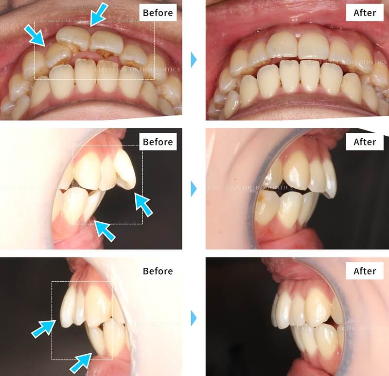 前歯が大きい理由って？オススメの矯正方法と費用について解説医療法人社団佑健会グループ