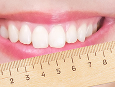 大きい前歯治療実例マウスピース矯正・裏側矯正の矯正歯科吉祥寺デンタルクリニック