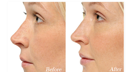 鷲鼻の原因を美容外科医が詳しく解説美容整形は東京シンデレラ美容外科