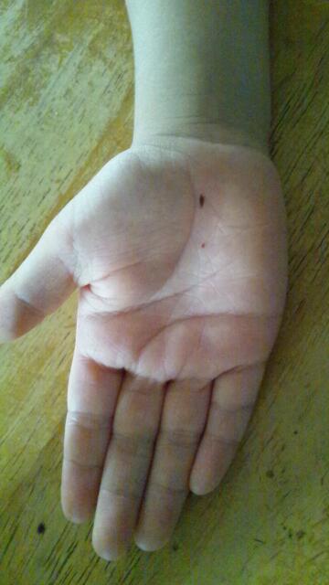 老人性血管腫 赤ほくろ は放置しても大丈夫?気になる対処方法赤ちゃん・子供のあざ治療なら最新レーザー治療×形成外科専門医の大阪梅田形成クリニック