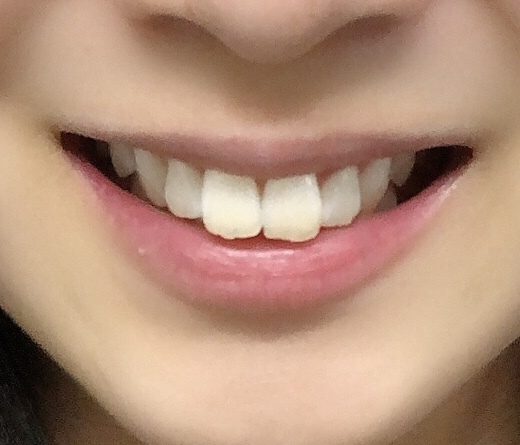 TWICE「ナヨン」前歯矯正? 「うさぎ感」薄まり、残念がる声 - デバク