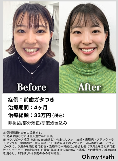 大きな前歯と、他人軸斉藤ナミ