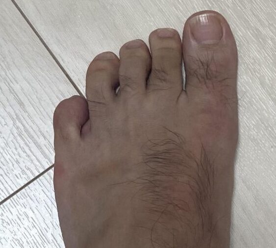 足の指の間の皮むけ 赤ちゃんの病気・ケガ ベビーカレンダー専門家相談