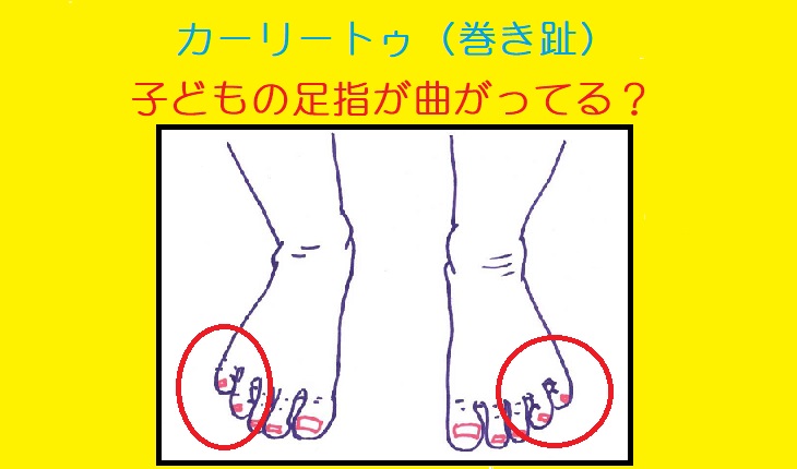 １歳2ヶ月、足の指を丸めて歩きます。 - 赤ちゃん・こどもの発育の悩み - 日本最大級 医師に相談できるQ&Aサイト アスクドクターズ