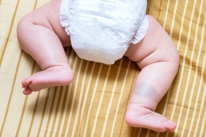 新生児のほくろについて知ろう!注意が必要なほくろや除去方法 - teniteo テニテオ