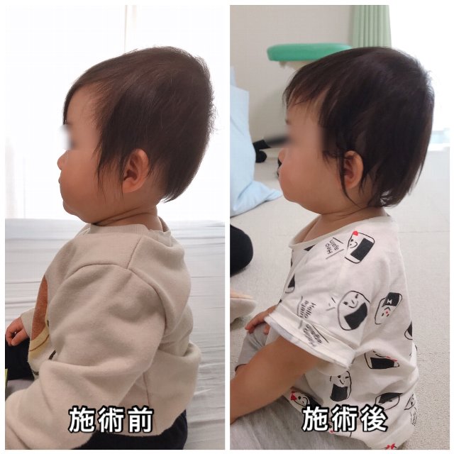 斜頭, 5ヶ月, ↓, 8ヶ月, 仰向きで寝ることが多く絶壁になってしまい来院, 向きぐせはすぐ改善し、後頭部に膨らみ、尖り感減少、ハチ張り減少,＠岡本整骨院, ☘️国家資格である柔道整復師, ☘️専門家監修の元に学んだ赤ちゃんの, 頭の形や発達について発信しています😊,☘️自宅でできるケアなども追加していきますのでお見逃しなく‼️, 過去の投稿はこちら,