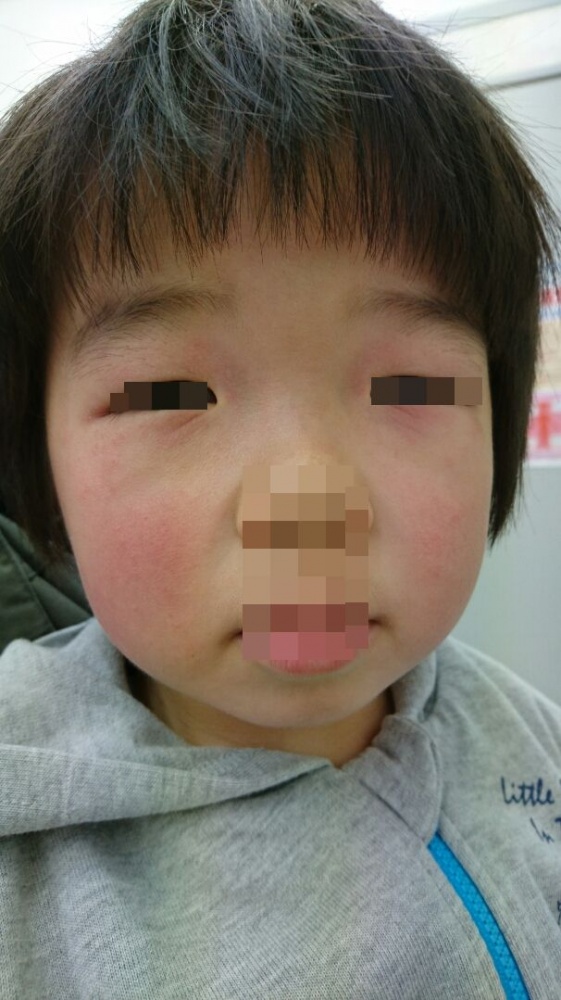 まぶたがはれる霰粒腫 ものもらいってどうしてできるの？ ママ眼科医 たまひよ