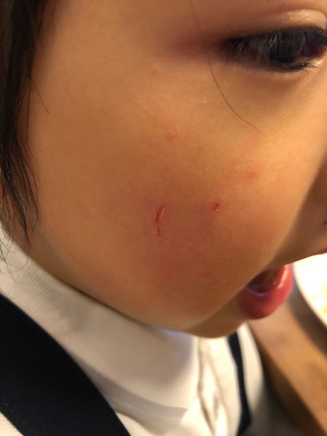 5m11d 顔のひっかき傷育児ブログ☆2017年8月に男の子を出産しました☆