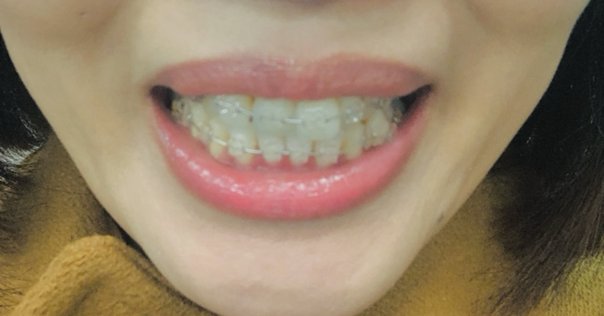 ザギトワ、沢尻エリカを参考に前歯は少し長めが綺麗？審美治療で知っておきたいこと