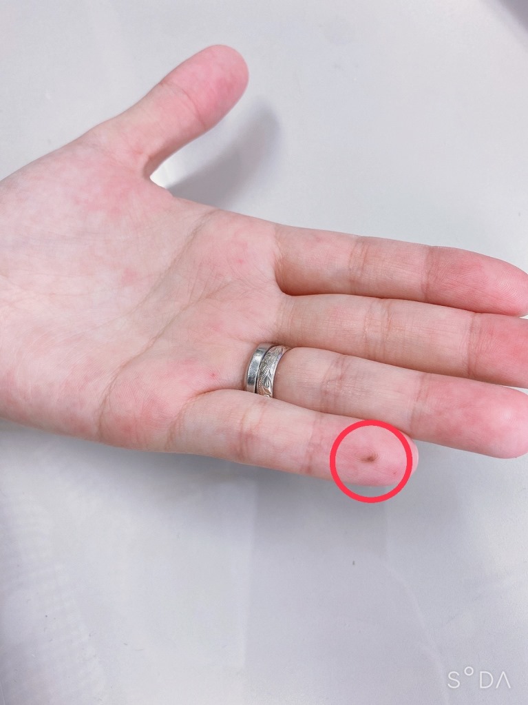 手のひらのほくろ : ようこそ☆¨はなかんざし¨へ