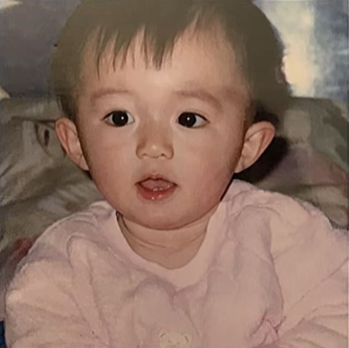 タレ目形成術と目尻切開ですっぴんでも可愛いタレ目に♪パーフェクトアイズの症例です 20代女性美容整形クリニックA CLINIC 公式