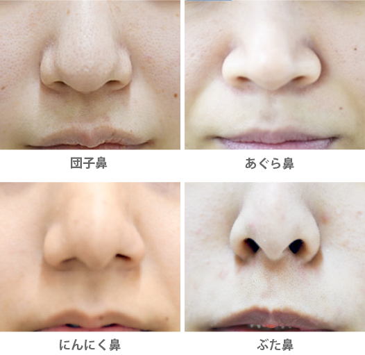 男性の鼻整形、女性の鼻との違いプレジャー美容整形外科