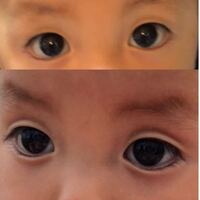 次女が生まれたとき、一重が二重かよく分からなかったです。2-3ヶ月のときはぽっちゃりさんで一重になりました。今は2歳半でめちゃめちゃ二重 です!赤ちゃんの顔につく脂肪のでせいで隠れてました笑