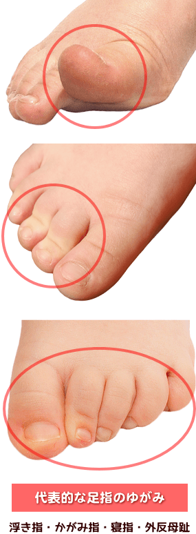 なぜ足の指を丸め込むのか？モチャモチャ日記 ダウン症