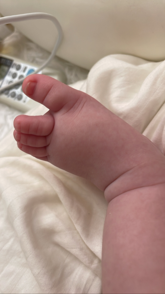 赤ちゃんの足の小指が長い？足の奇形について整形外科に聞いてみた障がい児ママ専門の就業支援をしたい難聴児ママのブログ