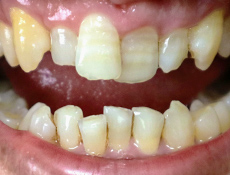大きな前歯を小さくするには福岡の審美歯科 セラミック矯正 美容歯科 博多プライベート歯科