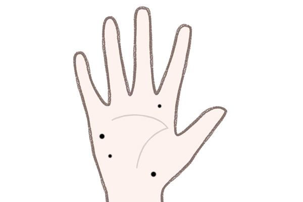 手のほくろ切除 - 美容外科船橋中央クリニック&青山セレスクリニック