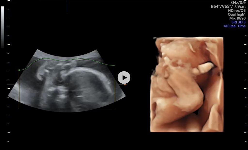 ずっと顔が見える状態なら難産かも – にしじまクリニックブログ