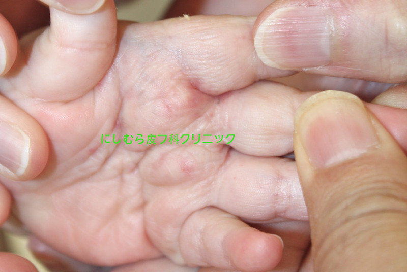 トゲ?ほくろ?? 赤ちゃんの心と体 ベビーカレンダー専門家相談