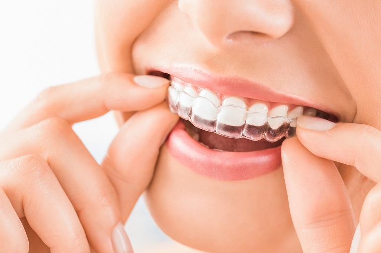 20代女性「前歯が大きいのが気になる」マウスピース矯正 インビザライン で治療した症例我孫子の歯医者さんなかむら歯科