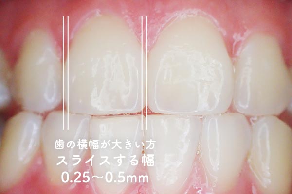 芸能人、有名人、スポーツ選手のガミースマイル 見えすぎる歯ぐき まとめ - 本町の矯正・歯科 本町ノーブル歯科 矯正歯科 歯並び・矯正無料相談 大阪本町の歯医者 ガミースマイル、歯並び、虫歯